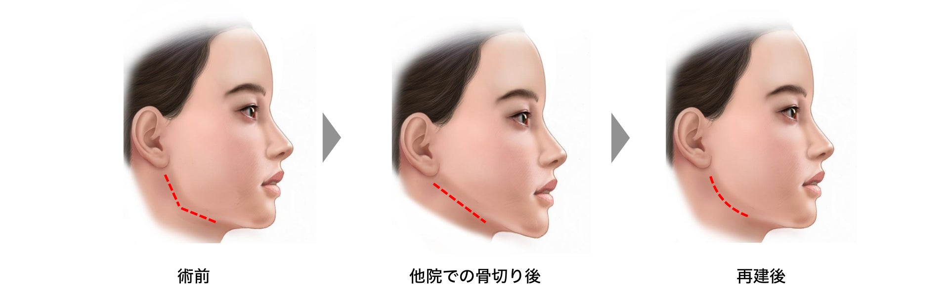 【日本初導入】自分の骨に置換される人工骨で『エラ再建プロジェクト』始動！救済措置として2025年5月8日(木)モニター募集開始