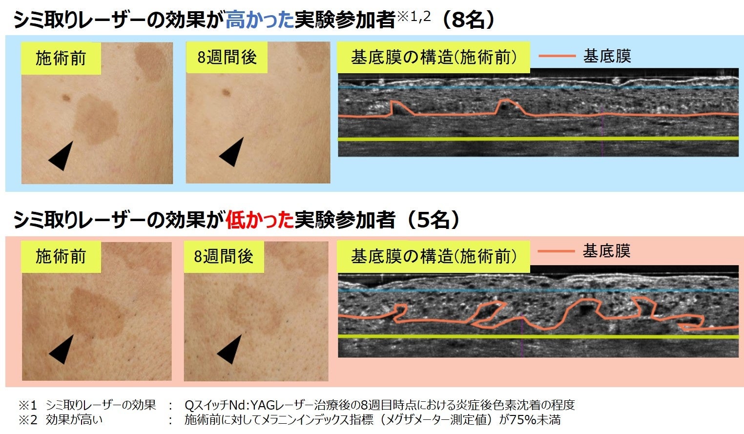 シミ取りレーザーの効果が 表皮の基底膜の凸凹度合いで変わることを発見