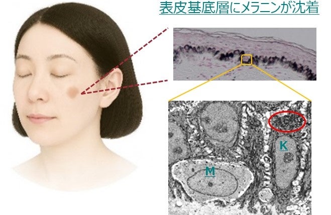 老化細胞が「掃除機」のようにメラニンを取り込む新事実を発見