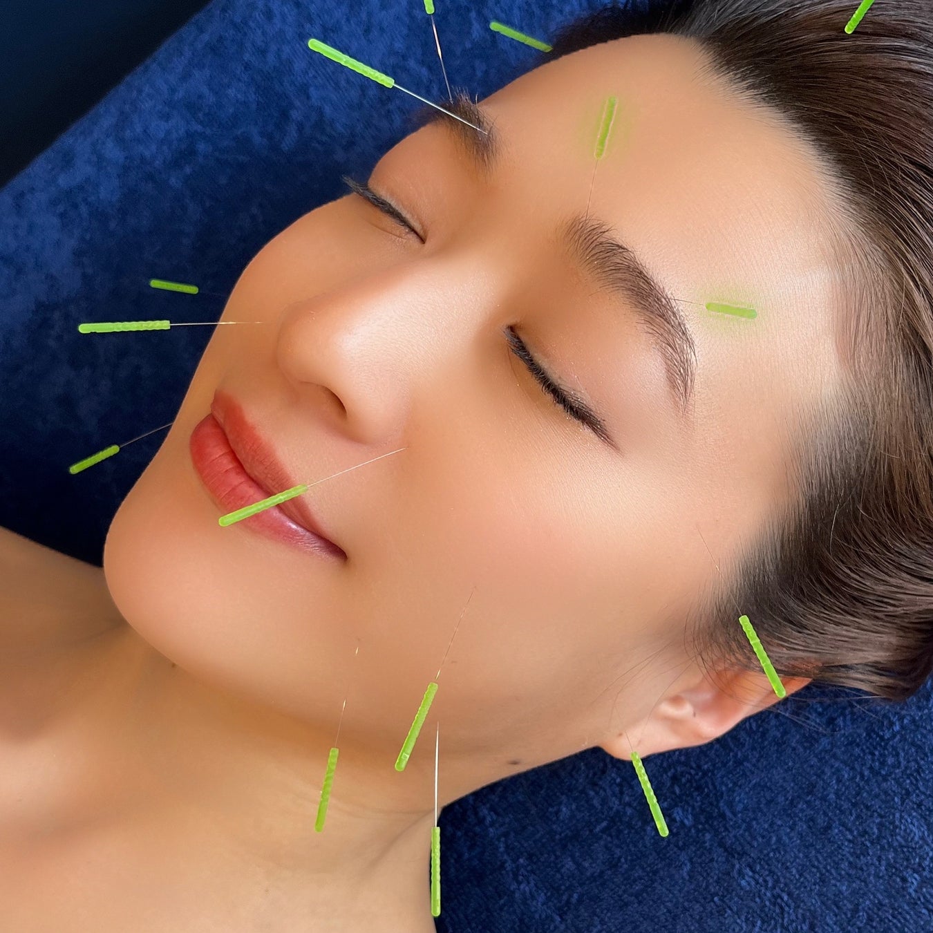 鍼灸業界に革命を！『Re:treat HARi』リトリートハリが叶える“美容鍼灸”