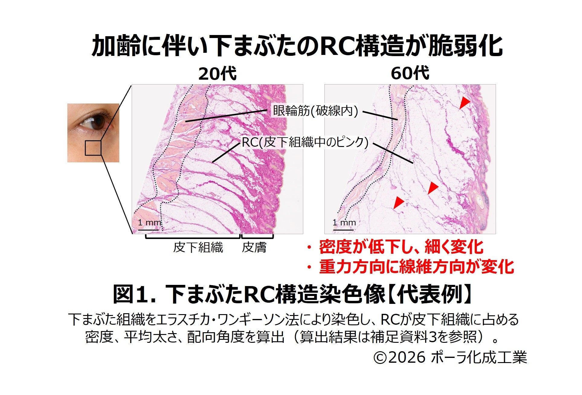 加齢で目立つ“目袋”に繋がる「下まぶたの構造変化」を解明